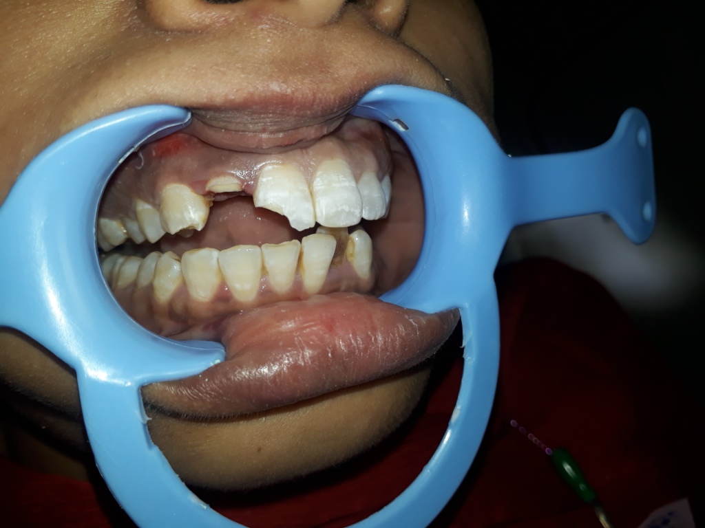 Fractured Front Teeth Rehabilitation